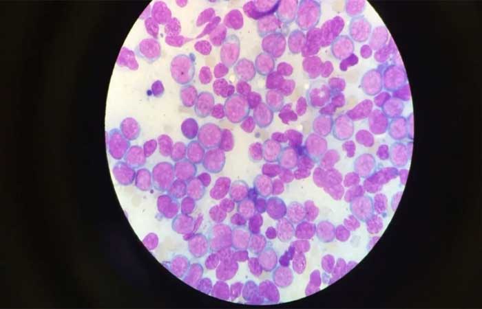Mutação genética que desencadeia leucemia aguda grave é descoberta