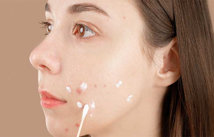 5 dicas para se livrar das acnes rapidamente, de acordo com dermatologistas