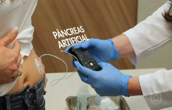 Brasil realiza o primeiro implante de pâncreas artificial