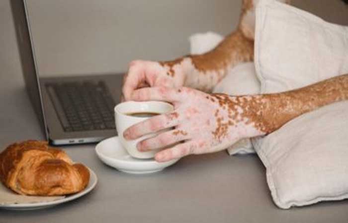 Doença autoimune: entenda como a alimentação influencia no vitiligo