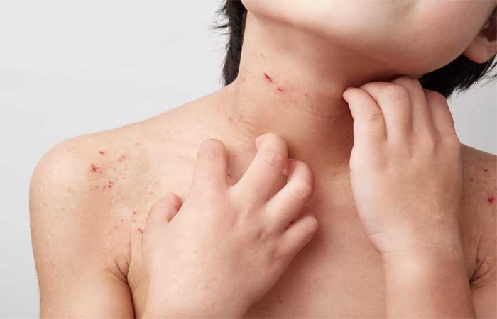 Casos de alergia em crianças aumentaram 7 vezes nos últimos 15 anos