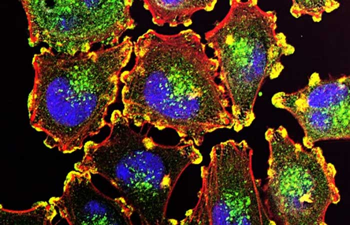Nova radioterapia a laser atinge tumores “na mosca” e poupa células saudáveis