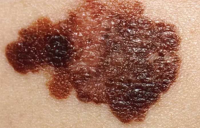 Câncer de pele: como identificar se pintas, manchas e outros sinais podem indicar doença