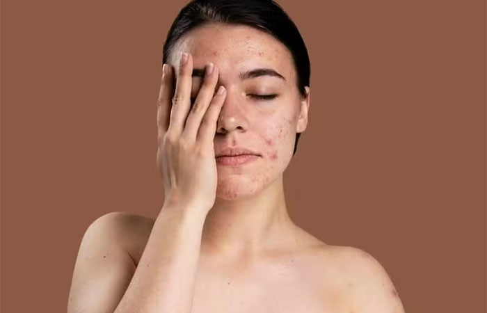 Aplicar alho cru para acne funciona? Entenda o que diz especialista