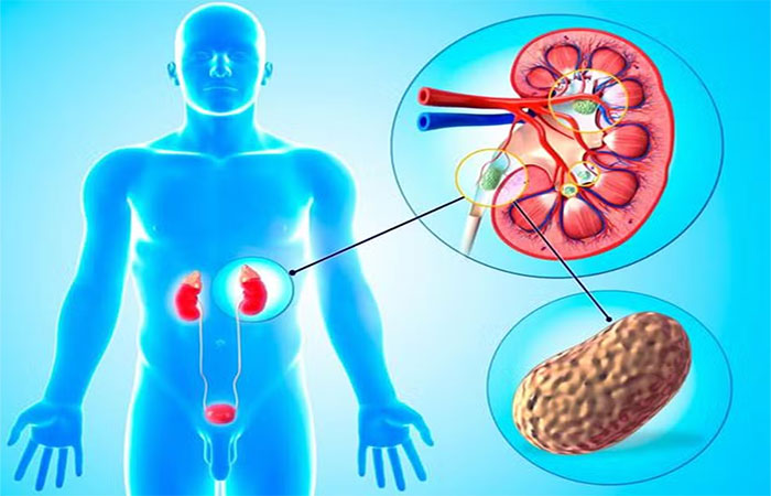 Cálculo nos rins e na garganta: quais pedras nosso corpo produz e como podemos evitá-las