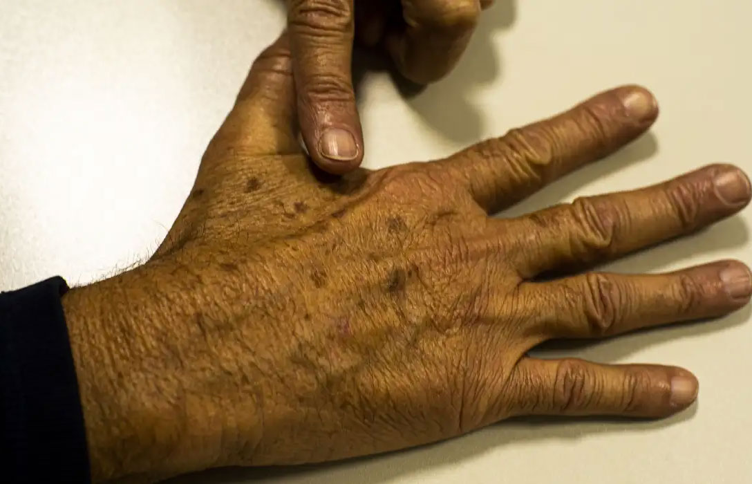 Dezembro Laranja alerta para a prevenção do câncer de pele no Brasil