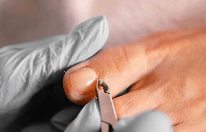 Os riscos de cortar mal as unhas dos pés: especialistas revelam a forma correta