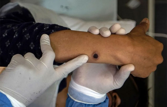 Mpox: SP confirma primeiro caso brasileiro de nova cepa responsável por surto na África