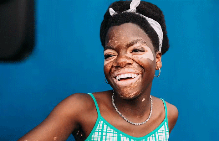 Vitiligo: o que é, causas, tratamento e como combater o estigma da condição de pele