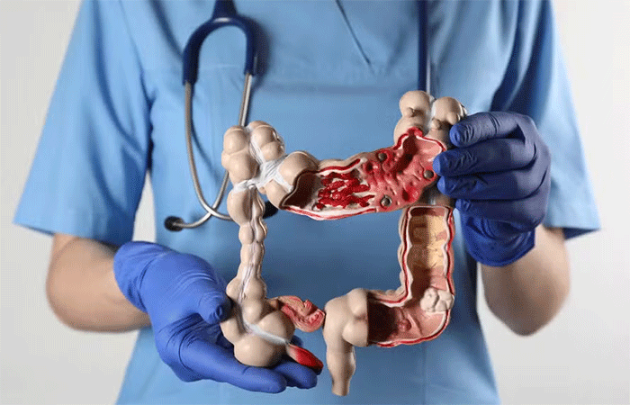O alimento que reduz em 20% o risco de câncer de intestino, segundo novo estudo