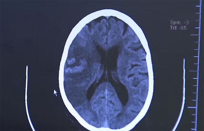 AVC tira a vida de um brasileiro a cada seis minutos; 80% dos casos poderiam ser evitados