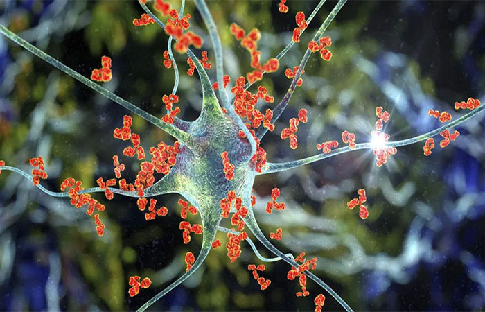 Esclerose múltipla danifica o cérebro muito antes de os sintomas aparecerem, e cientistas descobrem como