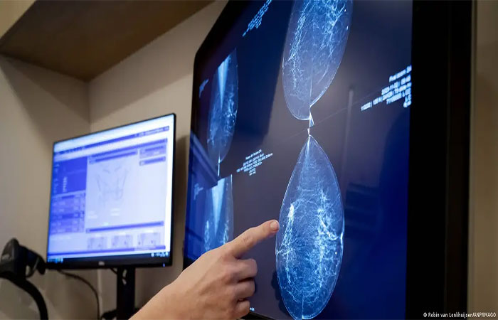 IA prevê risco de câncer de mama com 5 anos de antecedência