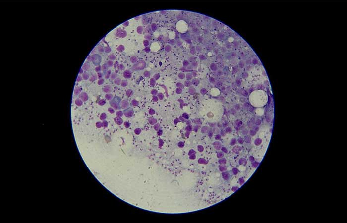 Leishmaniose visceral pode ser confundida com outras doenças do sangue